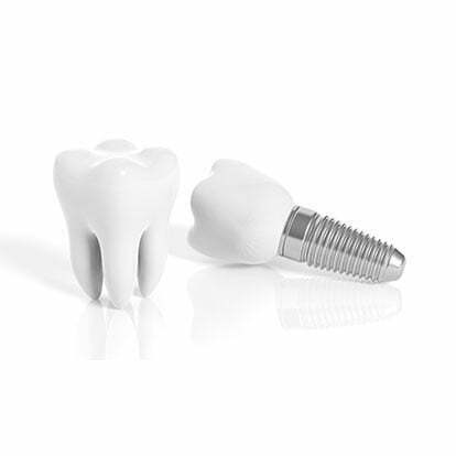 Four Things to Know Before Undergoing a Dental Implant Procedure