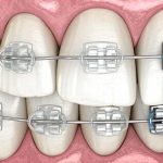 clear braces pros and cons