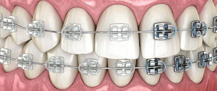 clear braces pros and cons