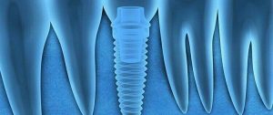 dental implants