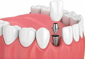 screw in dental implants