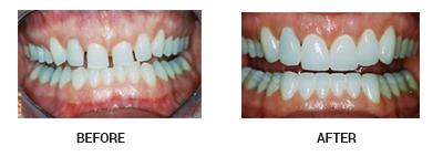 veneers before and after pictures