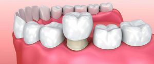 Dental crowns