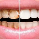 Teeth bonding before and after