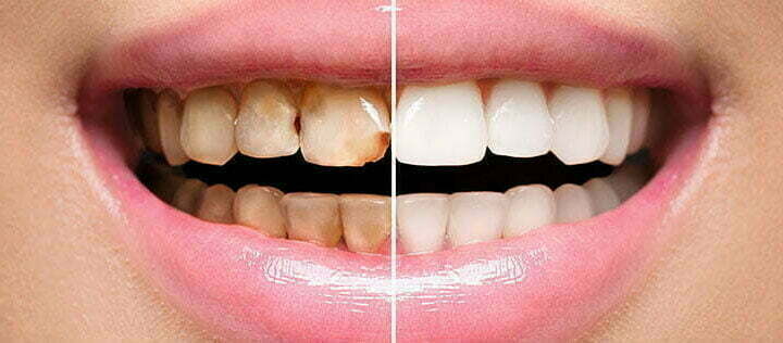 Teeth bonding before and after
