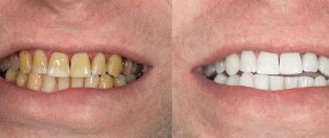 teeth whitening