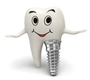 Dental-Implants-in-Arizona