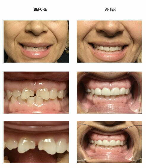 Before and after photos of dental patients in Phoenix AZ