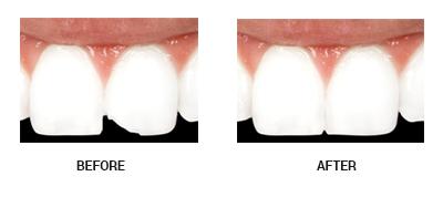 before and after dental bonding photos