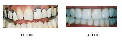before and after Sky Dental teeth restoration 