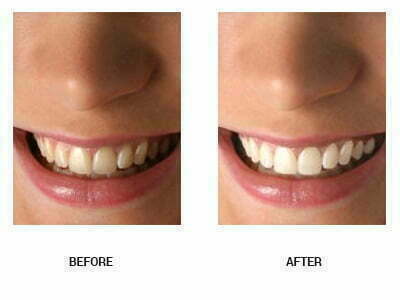 Before and after teeth whitening at Sky Dental in Phoenix AZ