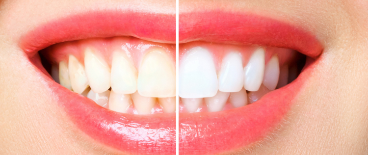Do Store-Bought Teeth Whitening Kits Really Work
